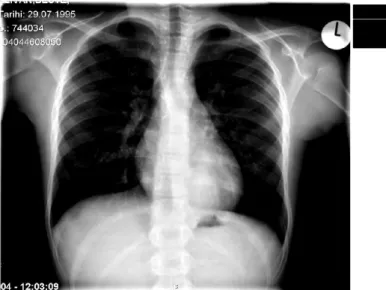 Figure   1.    Chest   radiograph   showing   dense   opacity   in posterior basal segment of the left lower lobe