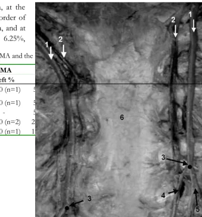Figure 1.    The sample of the IMA has two branches and different bifurcation levels on both sides (1: ima, 2: imv, 3: bifurcation point, 4: SEA, 5: MPA, 6: sternum)