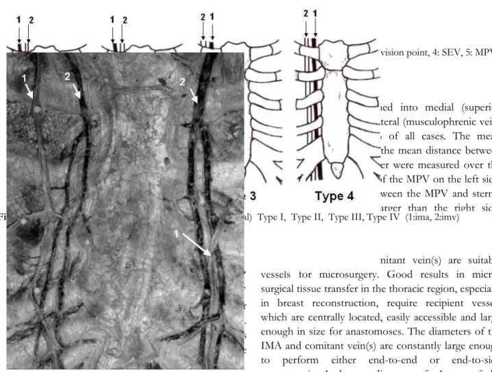 Figure 3.     The close localization of the venous junctions to the branching point of the IMA (1: ima, 2: imv)