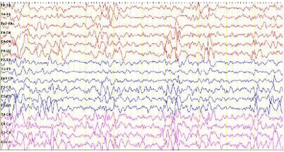 Figure 2.  Generalized spike and wave complexes in EEG of the patient 