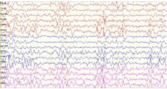 Figure 2.  Generalized spike and wave complexes in EEG of the patient 