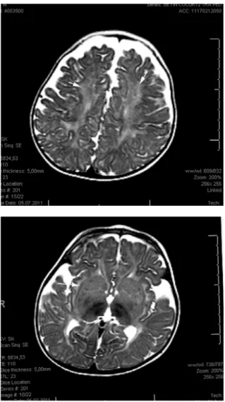Figure 3.  Follow up cranial T2 weighted MRI (a-b) images reveal 