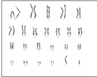 Şekil 3.     Metafaz kromozomlarının 100’lük büyütmede   Şekil 4.     Normal karyotip grüntüsü- 46,XX