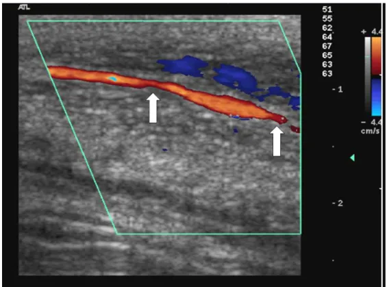 Figure 1.   Color Doppler image of right cavernous artery showing multiple stenosis (arrows) 