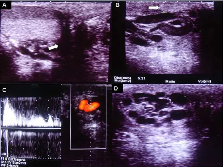 Figure 2.               A:  A:  A:  A: Hematoma formation around the left testis (arrow)