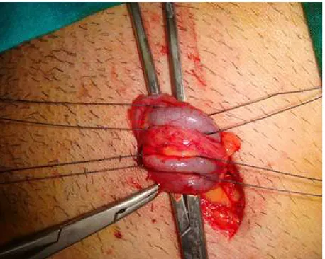 Figure 3.                View of the dilated varicose veins during operation        