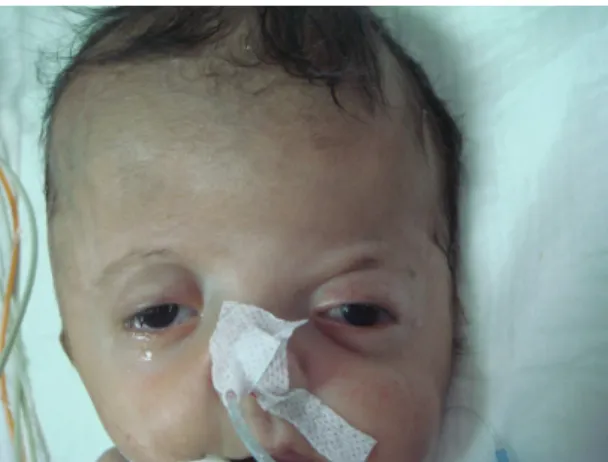 Figure 3.      Complete cleft palate in the midline 