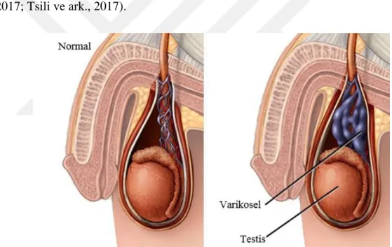 Şekil 2.6. Varikoselde toplardarın anormal genleşmesi  Kaynak: (Jensen ve ark., 1995) 