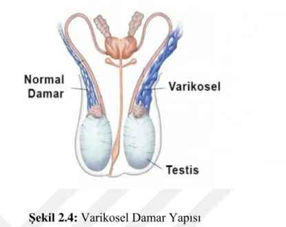 Şekil 2.4: Varikosel Damar Yapısı 