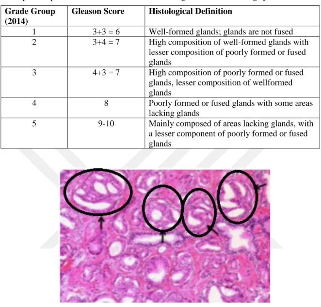 Figure  2.3.  Histological  representation  of  cribriform  glands  (gleason  pattern  4).Cribriform glands are indicated by the black arrows(Epstein et al