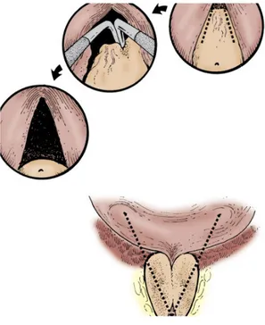 Şekil 9: Transüretral prostat insizyonu ( Mebust WK ‘ dan alınmıştır ). 