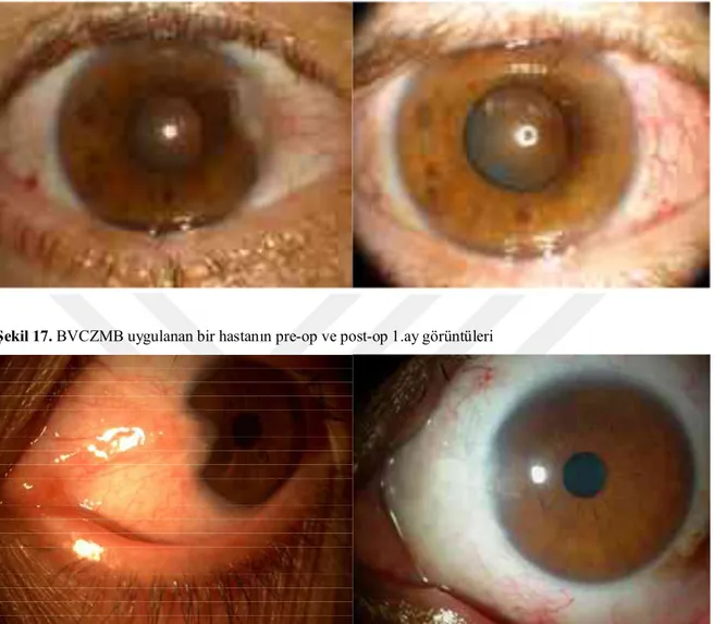Şekil 16. MMC uygulanan bir hastanın pre-op ve post-op 1.ay görüntüleri 