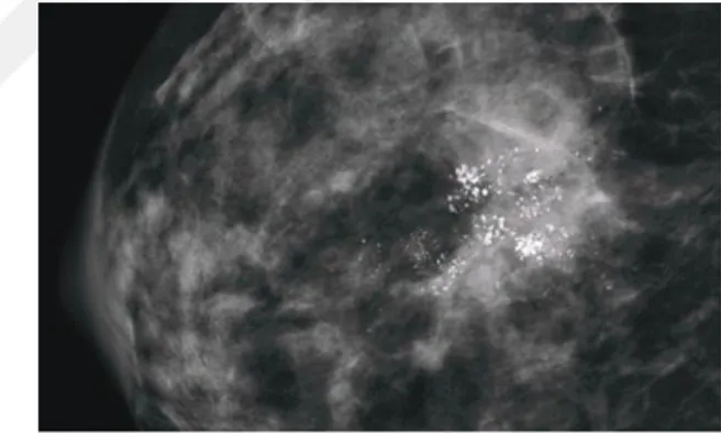 Şekil 9: Duktal karsinoma in situ mikroskobik kesit Şekil 10: Duktal karsinoma in situ mammografik  görünüm