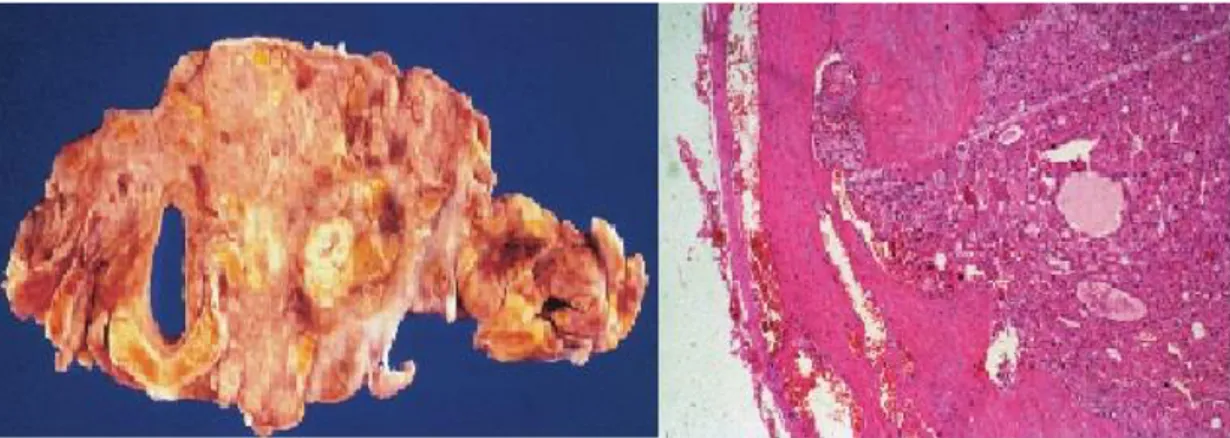 Şekil 6 : Foliküler tiroit kanserinin makroskopik ve mikroskopik görünümü (16). 