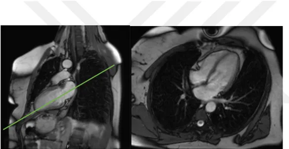 Şekil 6. 2 boşluk görüntü üzerinden sol ventrikül apeks ve mitral kapak ortasından geçen plan  ile elde olunan yalancı 4 boşluk görüntü  