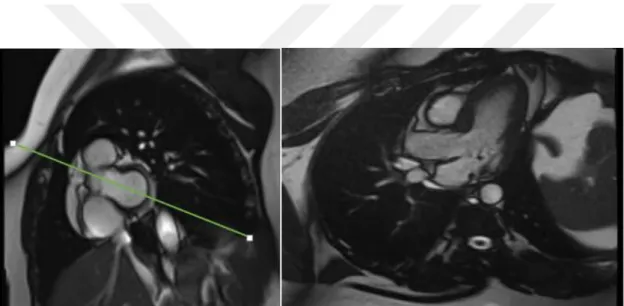 Şekil 9. Kısa aks görüntülerde aortun sol ventrikülden çıktığı kesit üzerinden aort aksına  paralel alınan plan ile elde olunan LVOT görüntü  