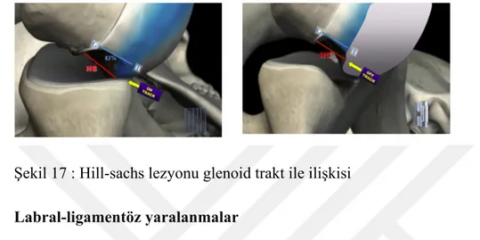 Şekil 17 : Hill-sachs lezyonu glenoid trakt ile ilişkisi  2.  Labral-ligamentöz yaralanmalar 