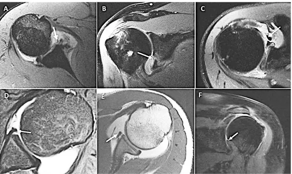 Şekil  19:  Travmatik  anterior  yaralanmalarda  MRI.  A)  Bankart  lezyonu.  B)  Kemik  bankart  lezyonu