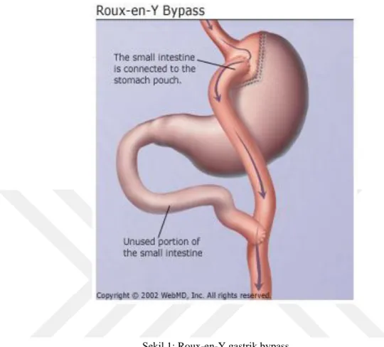 Şekil 1: Roux-en-Y gastrik bypass 