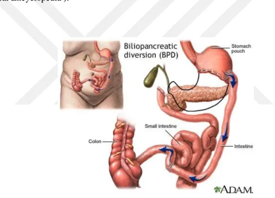 Şekil 4: Biliyopankreatik diversiyon (BPD) 