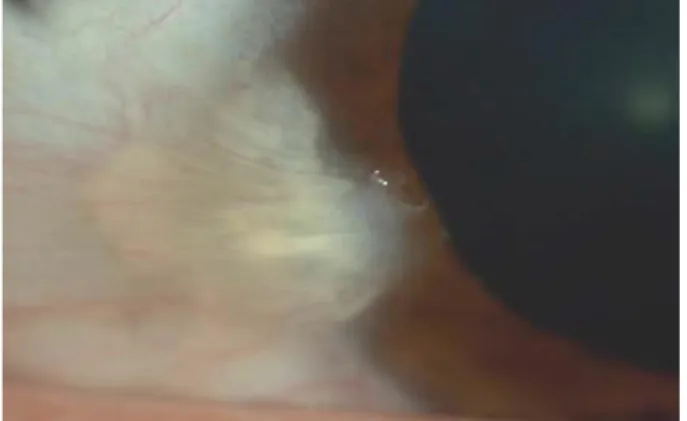 Şekil 1. Tip 1 fibröz pterjium 