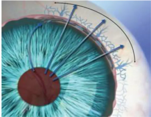 Şekil 8. Ön kamarada girişe sahip olan Hydrus implantı,  Schlemm  kanalına  direkt  olarak  hümör  aköz  girişini  sağlar  ve  üç  pencere  yüzeyi  ile  iç  duvardan  rahatca  hümör  aközün  kolektör  kanallara  ve  aköz  venlere  geçişine izin  verir [105