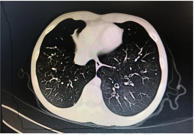 Şekil 3.  Bronşiolitis obliteranslı bir hastada akciğer BT de; mozaik perfüzyon, buzlu cam  görünümü, bronşiektazi görünümü  