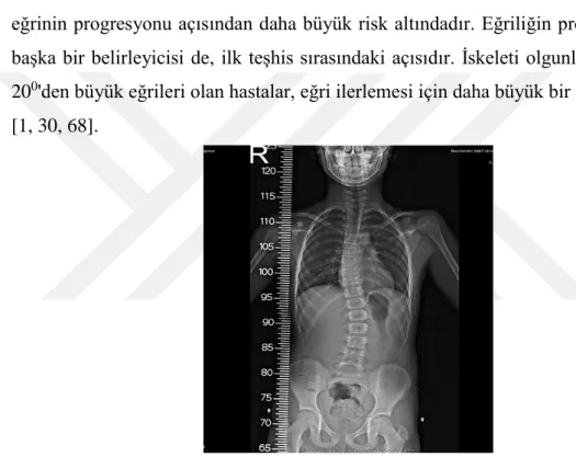 Şekil 2.2 : Adölesan İdiopatik Skolyoz 