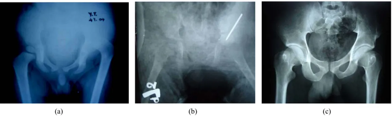 Figure 1. (a) Male patient 4 years of age with left hip high-riding dislocation (Tönnis grade IV)
