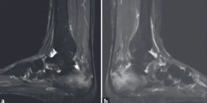 Figure 2: (a) Right and (b) Left Bilateral ankle MRI showed normal  findings in T2 sequence images at one year follow up