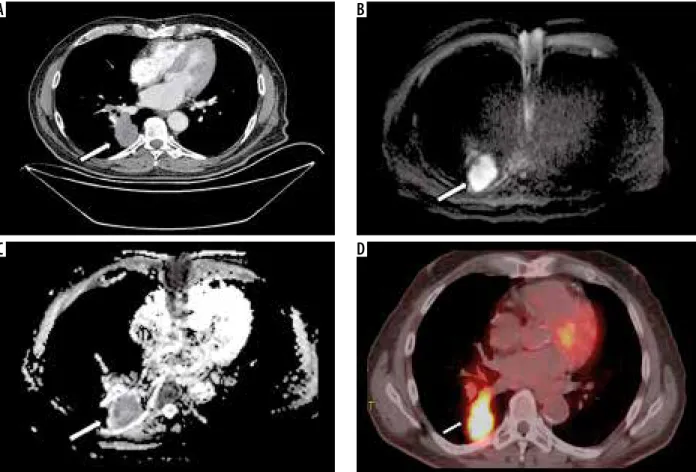 Figure 1. Image examples of a 57-year-old patient with small cell carcinoma of the right lower lobe