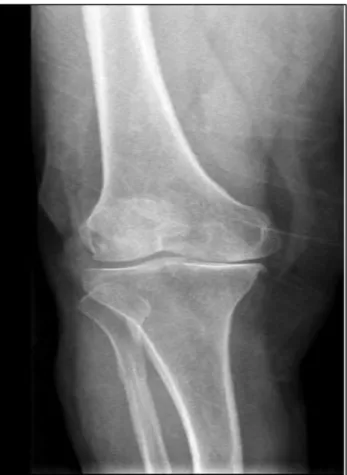 Figure 2: The knee roentgenographie of Kellgren- Kellgren-Lawrence stage 4. 