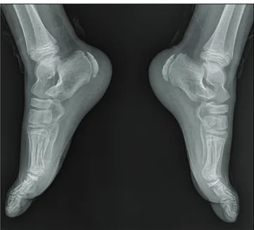 Figure 1. Lateral calcaneus X-ray graphy of a 10-year-old boy with bilateral heel  pain