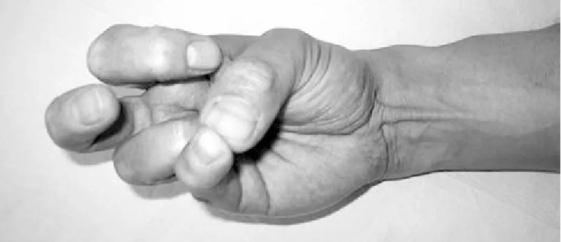 Figure 1. Demonstration of the palmaris longus muscle through the classical method.
