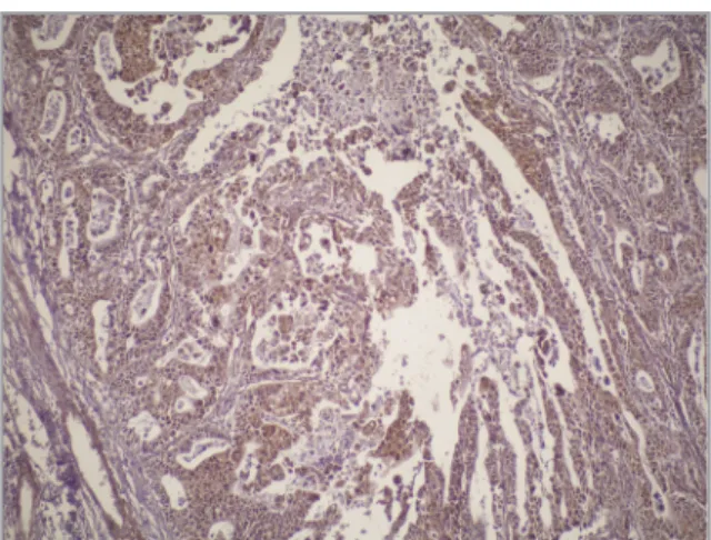 Figure 2. Immunohistochemical expression of GSTK1 isoen-