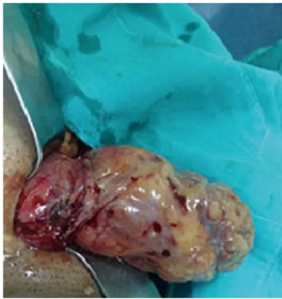 Figure 1  Hernia sac with appendicitis. Figure 2  Pathological view for acute gangrenous appendicitis.