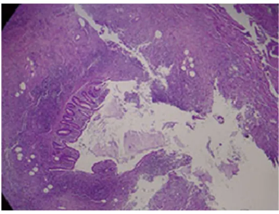 Figure 3  The appendix was found to adhere to the inner surface of the 
