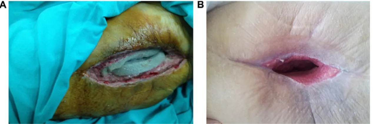 Figure 2 Wound appearance at 2 weeks (A) and 7 weeks (B) following the operation (case 1).