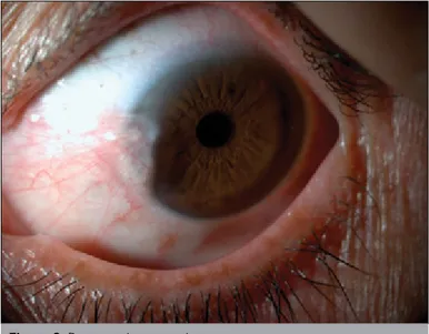 Figure 3. Postoperative image of a case that underwent a limboconjunctival 