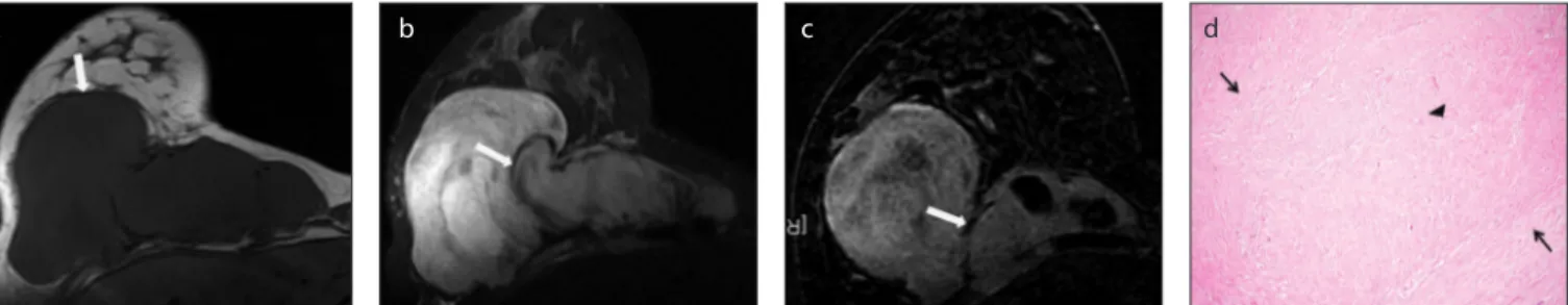 Figure 2. a–d. Focal fibrosis of the breast. Left mediolateral oblique (MLO) projection of mammography (a) shows a high density, irregular mass lesion (arrow) 