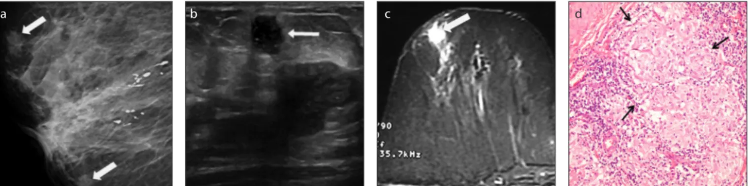 Figure 4. a–d. Tubular adenoma. Left craniocaudal projection of mammography (a) shows an oval, circumscribed, equal density mass (arrow) with 