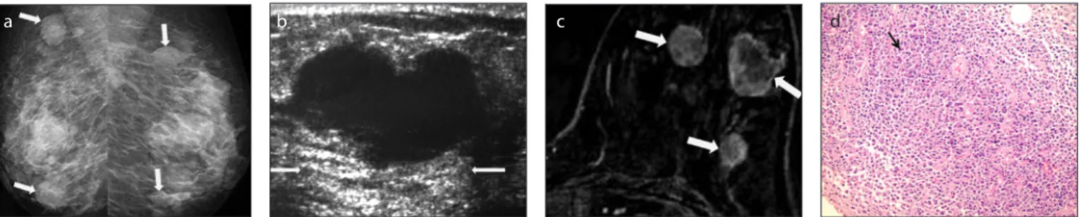 Figure 11. a–d. Metaplastic carcinoma. Right CC projection of mammography (a) shows an oval, high density lesion (arrows) with obscured margin