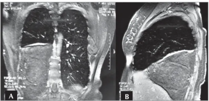Figure 4. On coronal (A) and sagittal (B) STIR images, the mass signal intensity was consistent with the fat tissue.