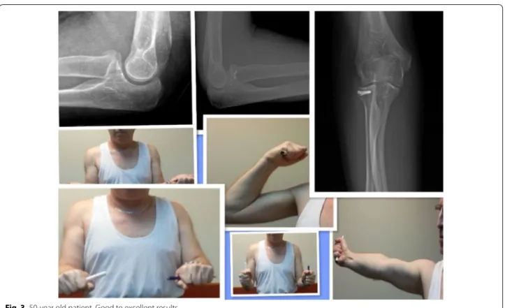 Fig. 3  50-year old patient. Good to excellent results