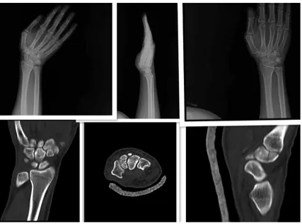 Figure 2.  Right hand scaphoid view; Right hand lateral; Right hand AP;  Right hand coronal CT; Right hand axial CT; Right hand sagittal CT  (trape-zoid fracture is observed)