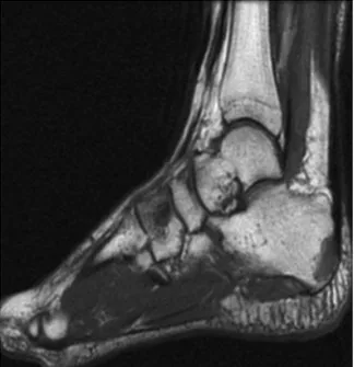 Fig. 5 Hypointense lesions in calcaneus and cuneiform (T1-weighted magnetic resonance imaging section).