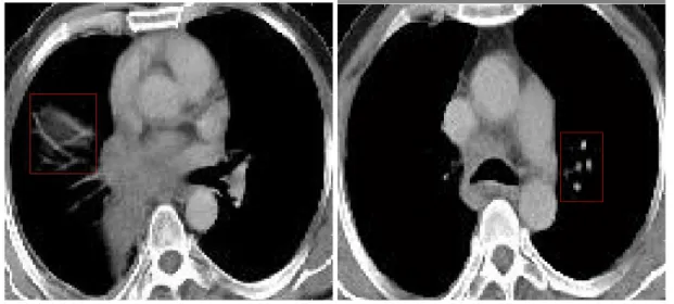 Figure 2.1: A sample Computerized Lung Tomography Image from the Data Set.  a) Non Cancer Lung Mass   b)  Cancer Lung Mass 