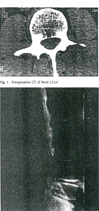Fig.  2 :  MyelograP.hY  showed  a  complete  block  at  L3  l"vd  and  narrowing of L4·5