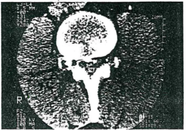 Fig. 3 ,  Post myelographic CT  revealed  a  soft  tissue  mass. 