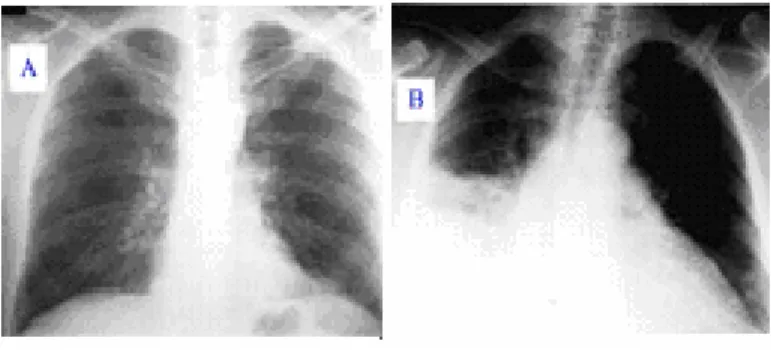 Figure 3.1. Breast Roentgenogram 